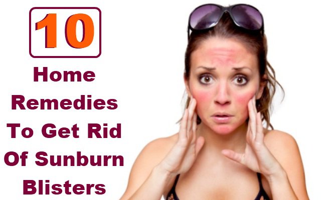 Remedies to get rid of sunburn