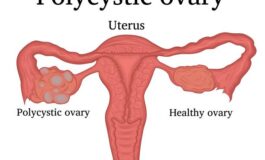 Unveiling the Challenges and Management of Polycystic Ovary Syndrome (PCOS)