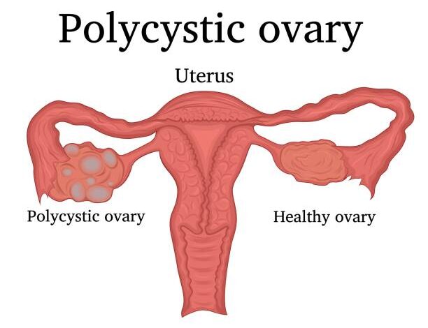Unveiling the Challenges and Management of Polycystic Ovary Syndrome (PCOS)